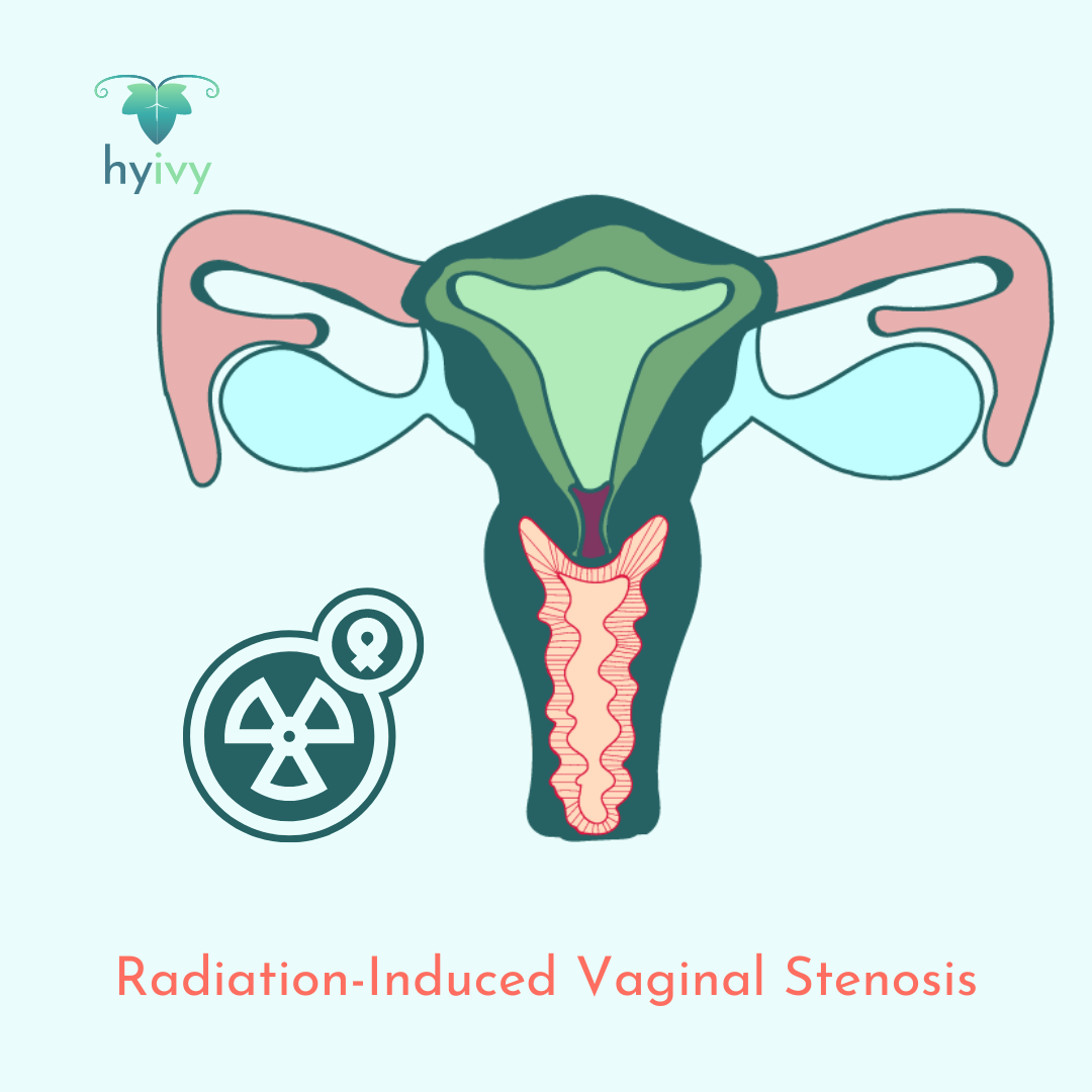 Radiation-Induced Vaginal Stenosis