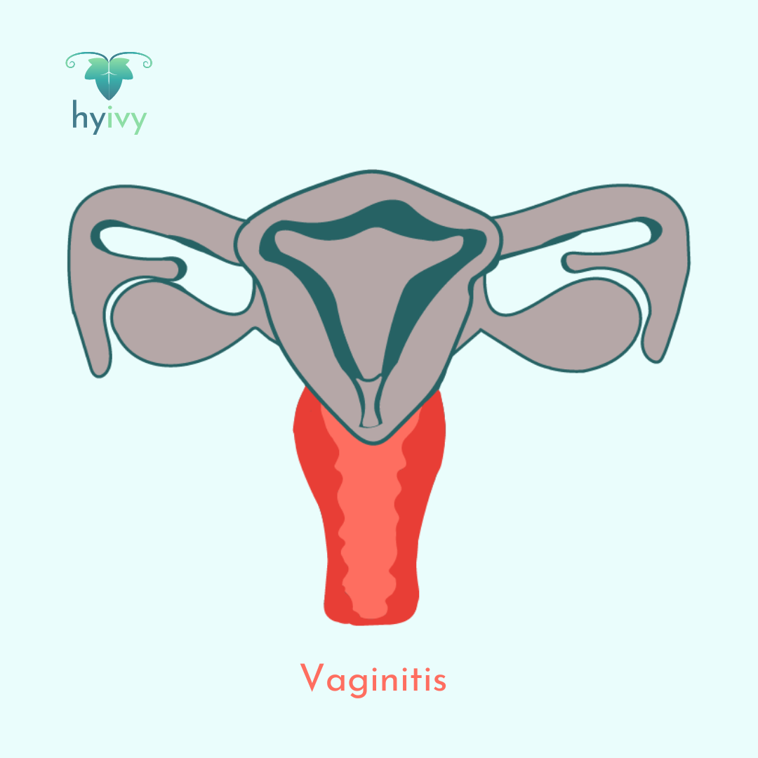 Vaginitis 