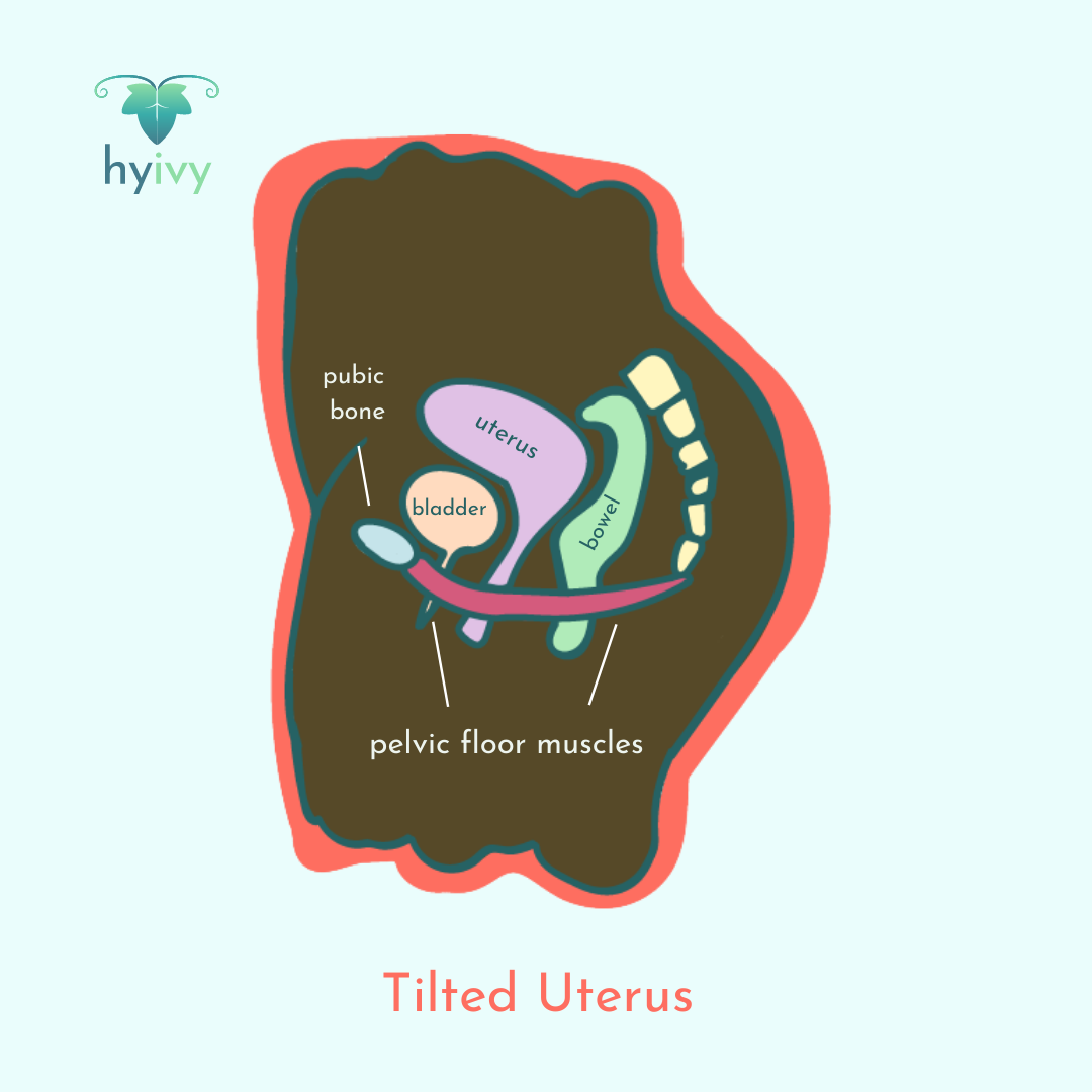 Tilted Uterus