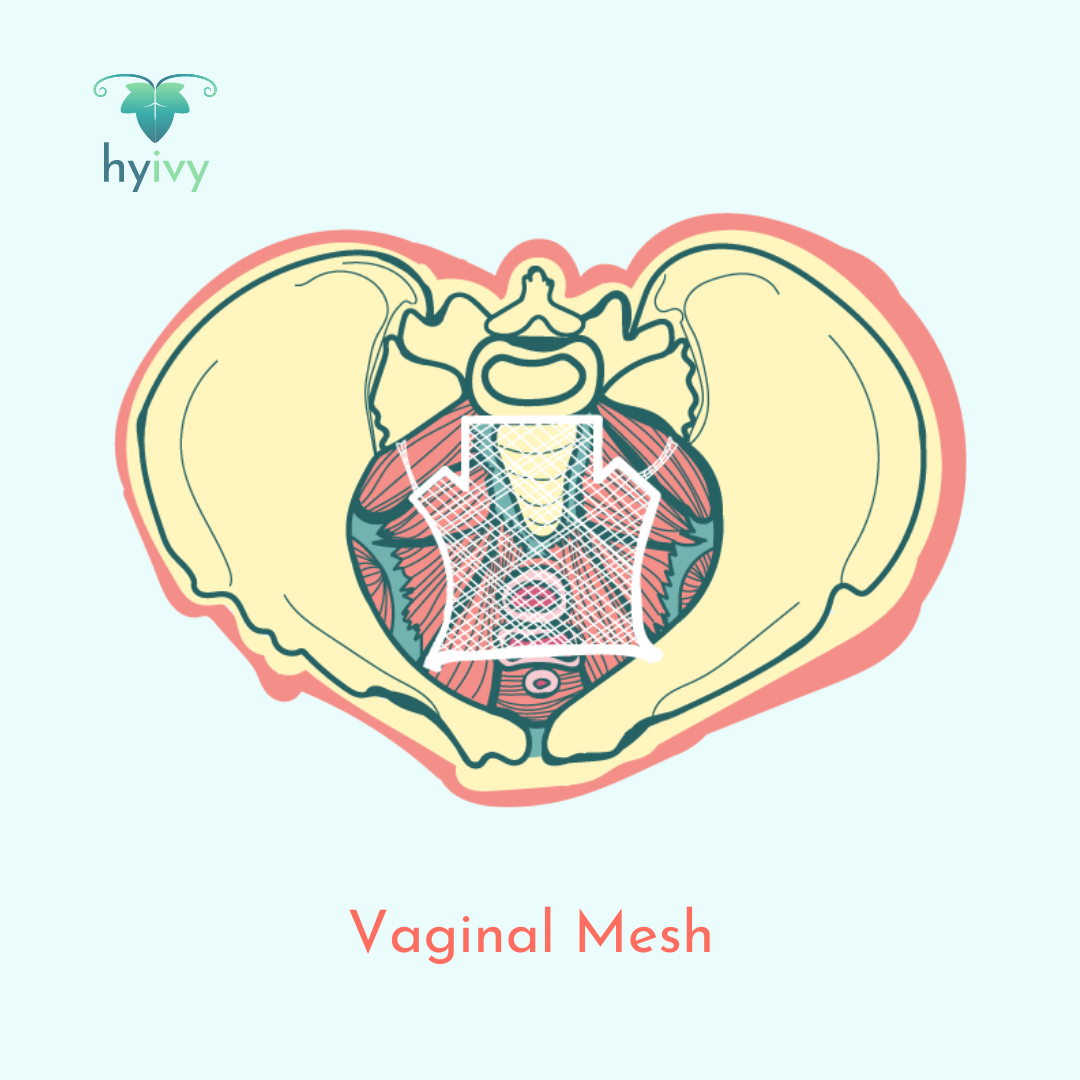 Vaginal Mesh