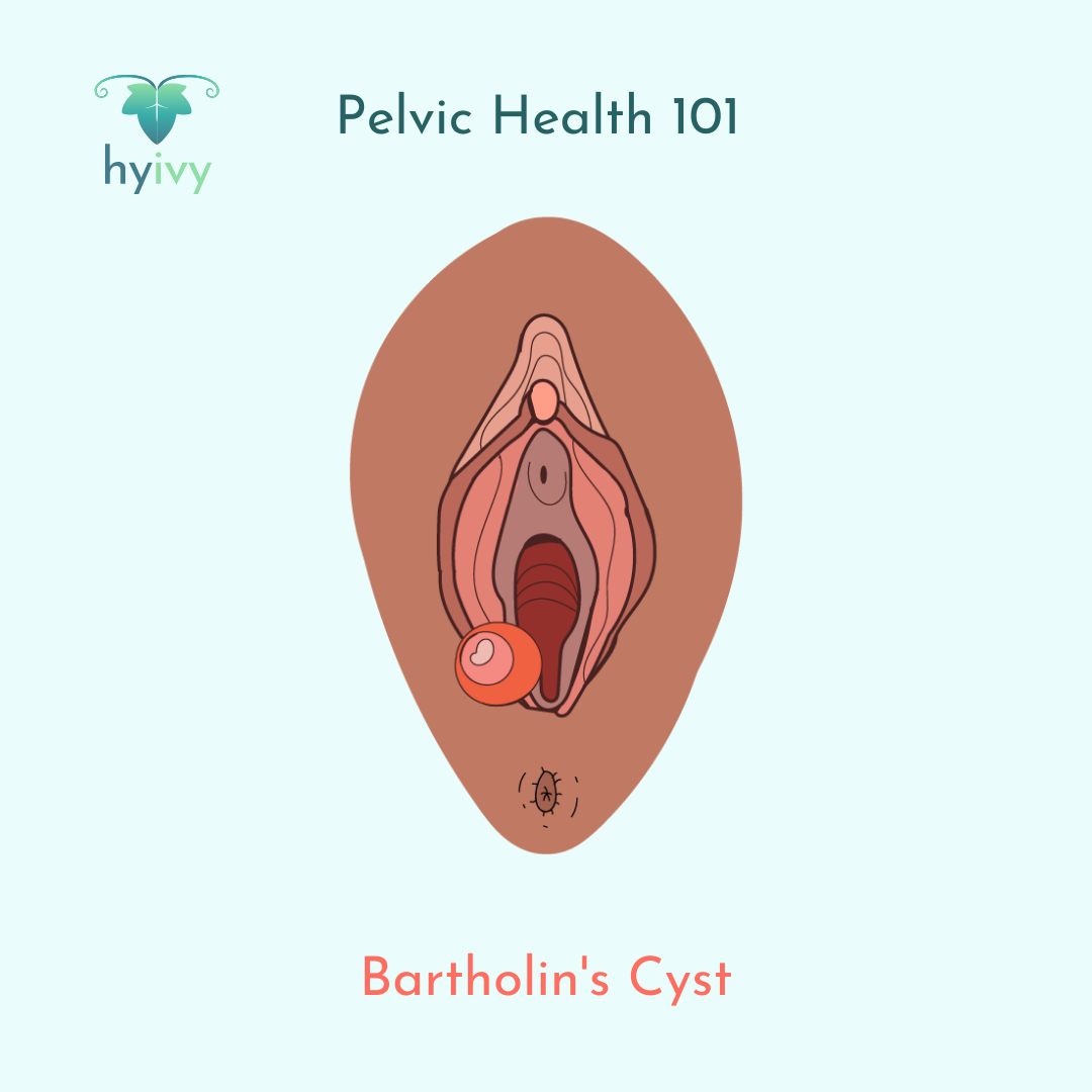 Bartholin's Cyst